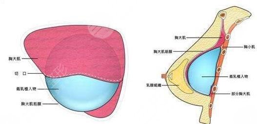 內(nèi)窺鏡隆胸