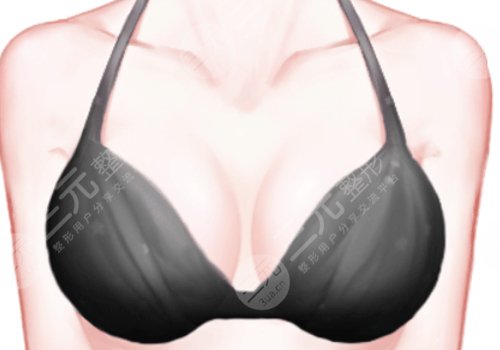 南昌二附院隆胸價格