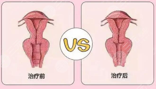 緊縮針