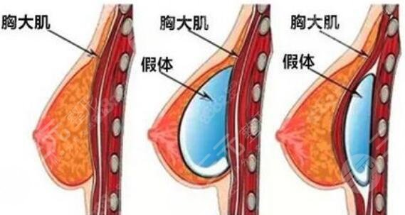 隆胸