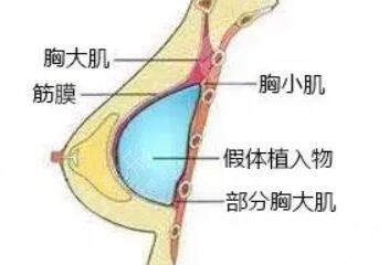 隆胸