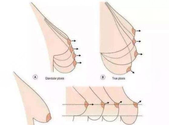 乳房下垂