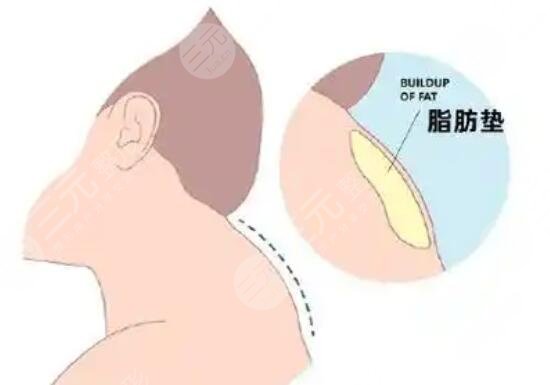 富貴包吸脂