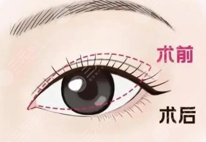 雙眼皮