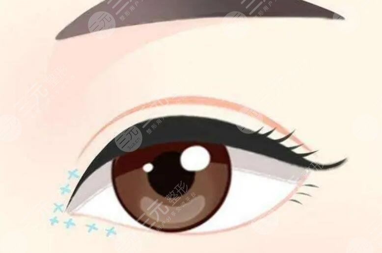 雙眼皮