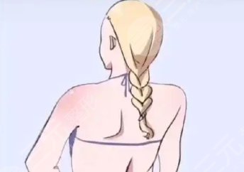 吸脂瘦后背