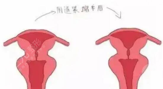 私密緊縮