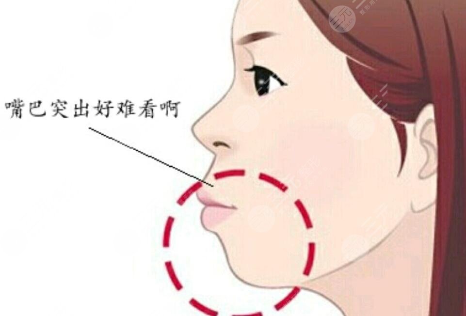 凸嘴