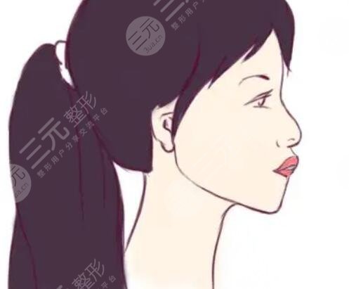 凸嘴矯正