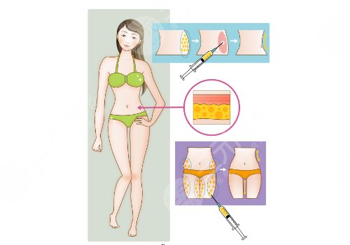 定第一中心醫(yī)院吸脂多少錢