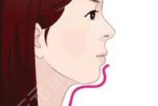 頜成型