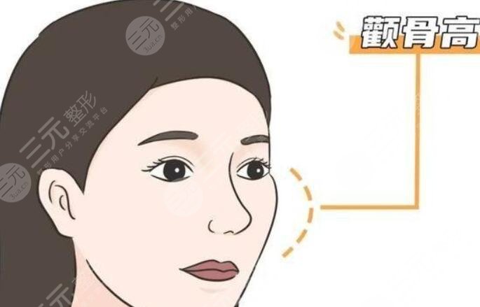 顴骨整形