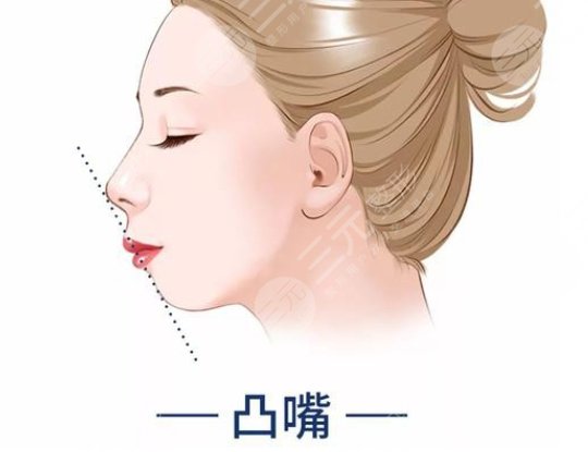 凸嘴
