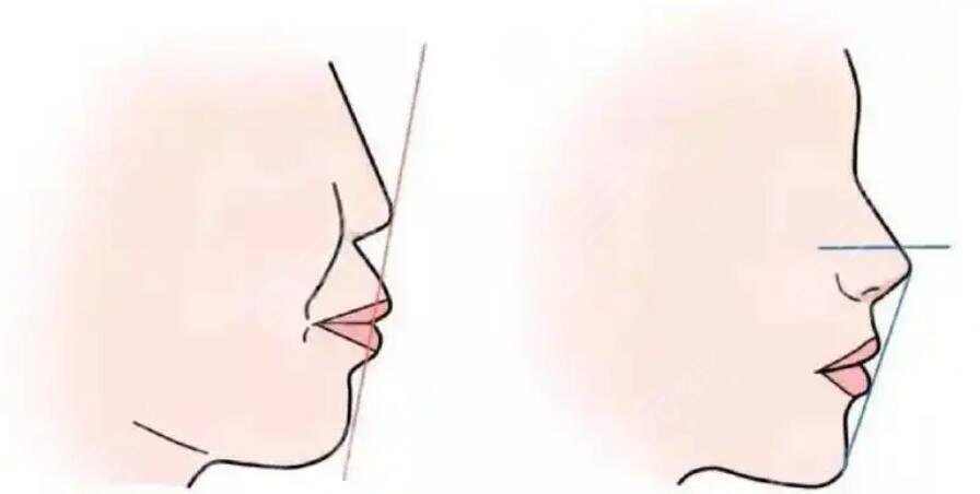 凸嘴