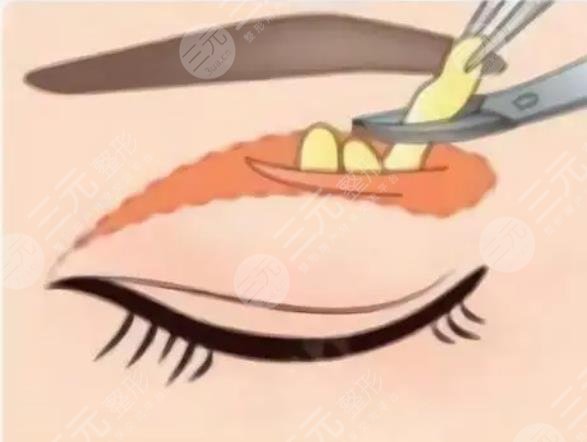 雙眼皮