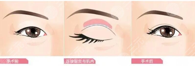 雙眼皮修復