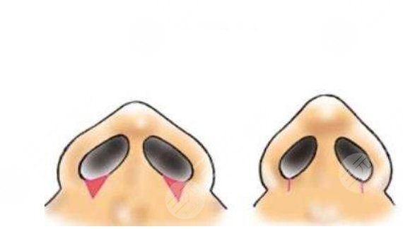 鼻翼