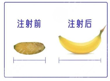 增粗手術(shù)