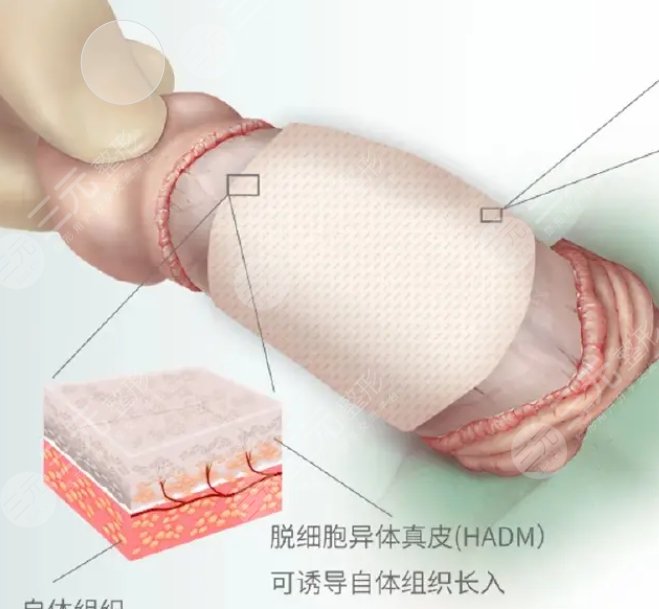 增粗