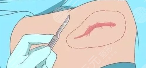 疤痕