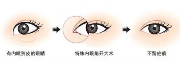 開內(nèi)眼角