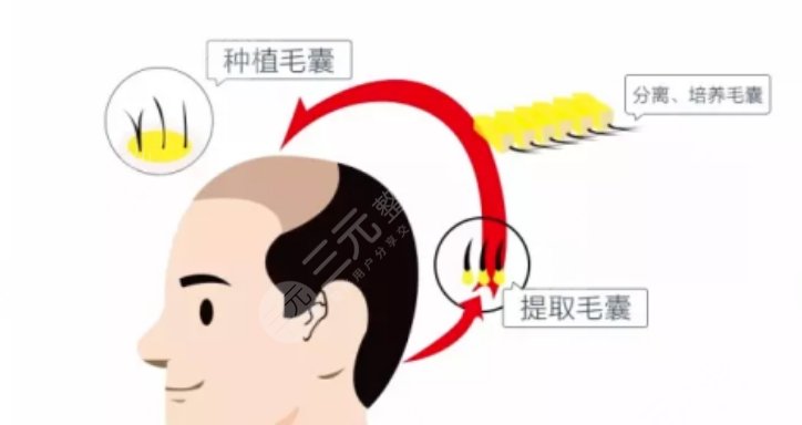 植發(fā)