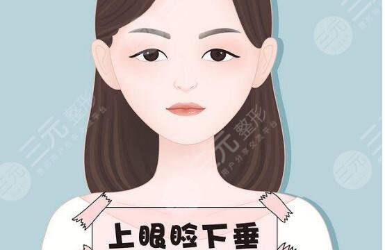 上瞼下垂矯正
