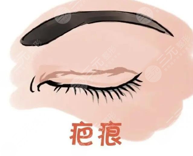 雙眼皮