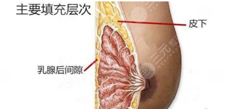 脂肪隆胸