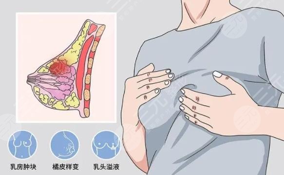 脂肪隆胸