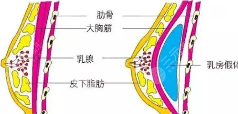 隆胸