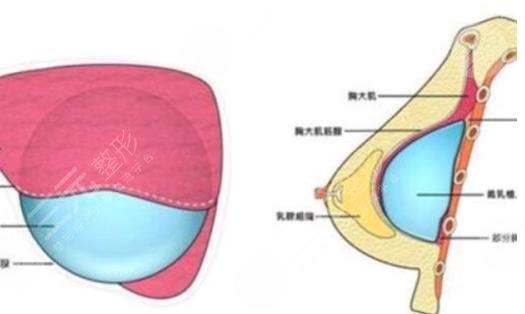 假體隆胸