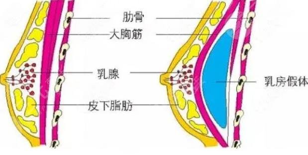假體隆胸