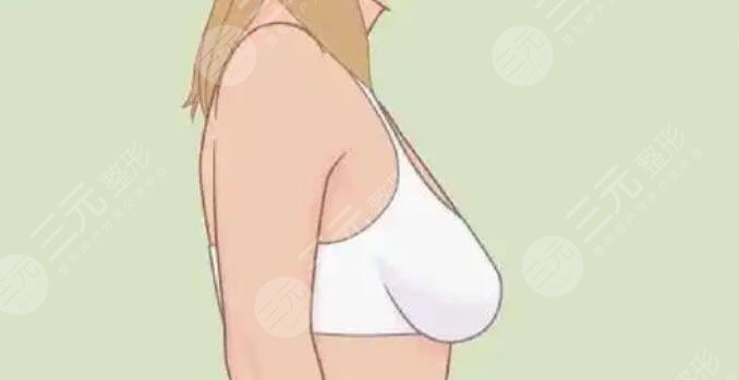 隆胸