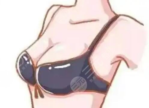 隆胸