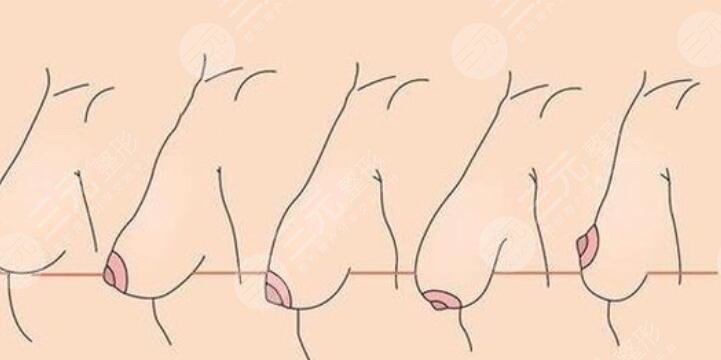 胸部下垂