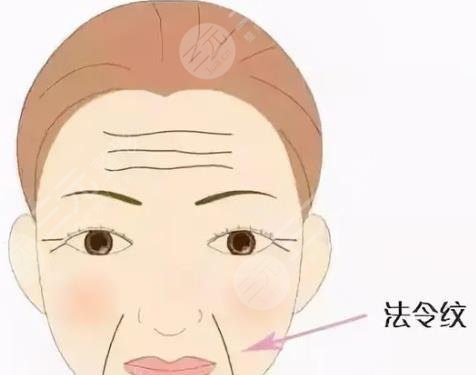 法令紋