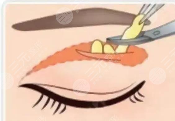 雙眼皮