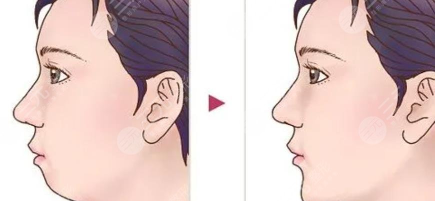 下頜角