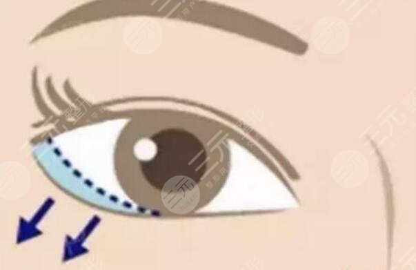 眼瞼矯正
