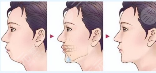 下巴后縮