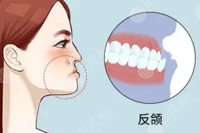 反頜矯正手術(shù)