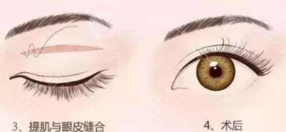 雙眼皮