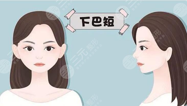 下巴后縮