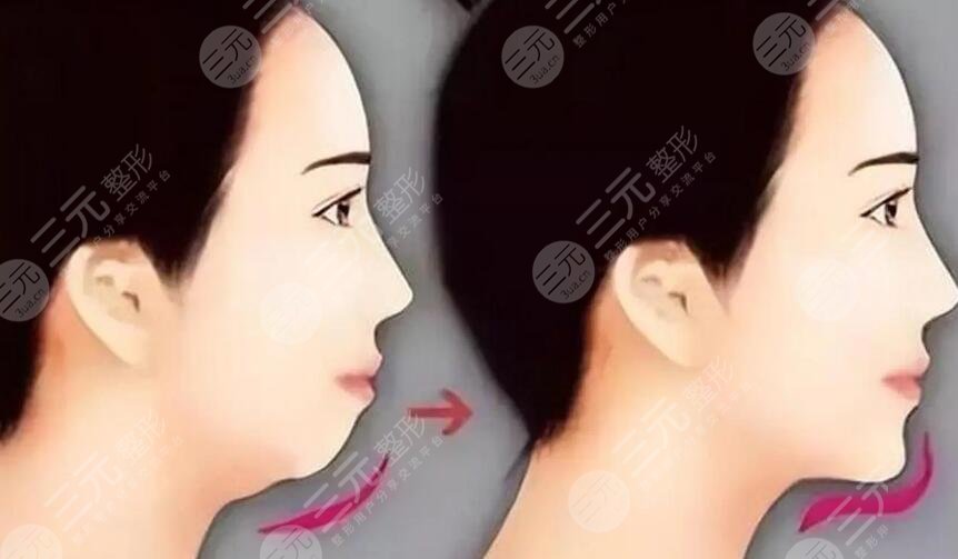 下巴后縮