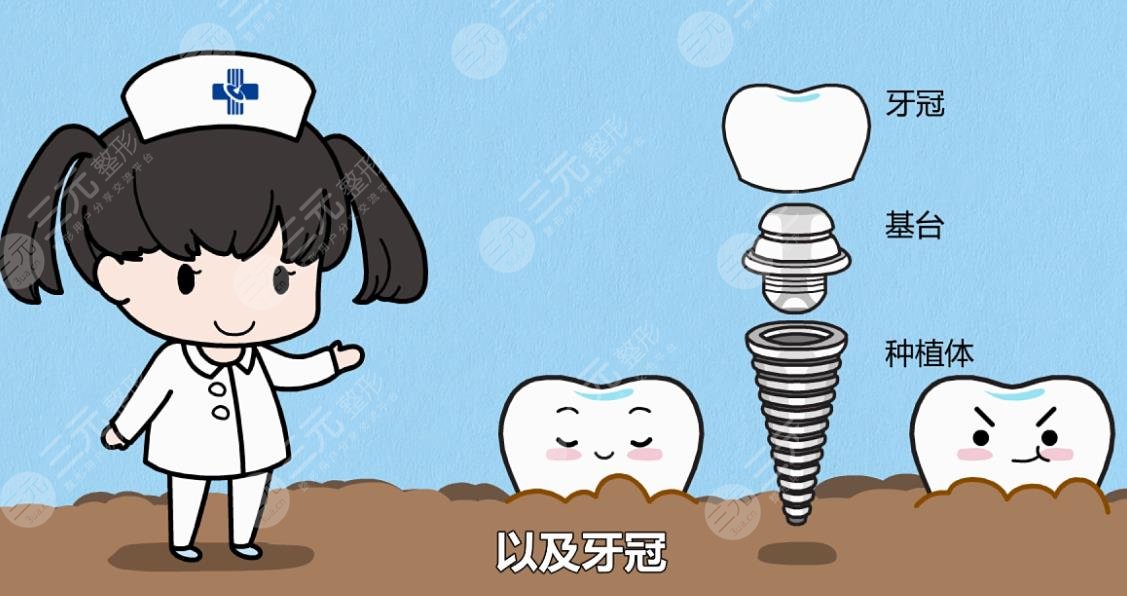 牙齒種植