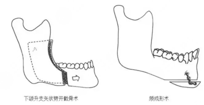 頦成型