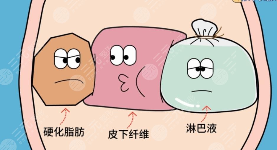 吸脂手術