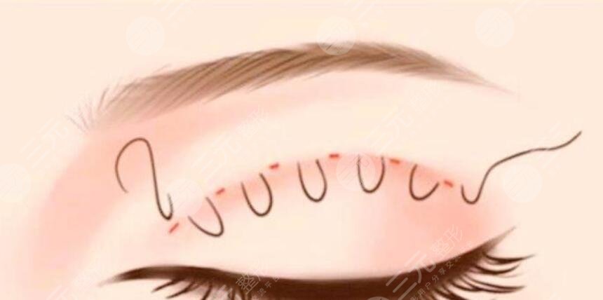 雙眼皮