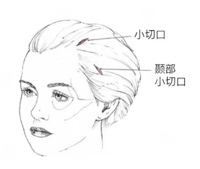 拉皮